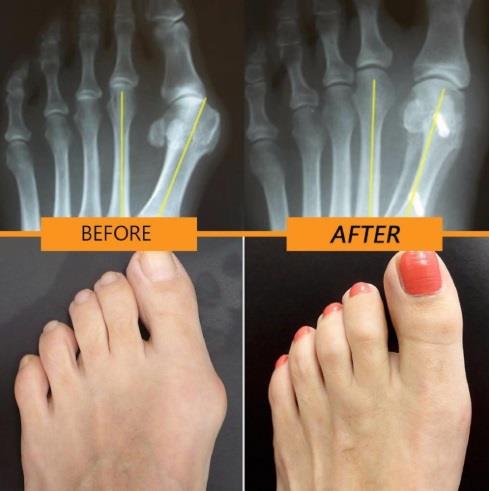 Day Night Bunion Splint Big Toe Corr End 5 29 2020 8 15 Am