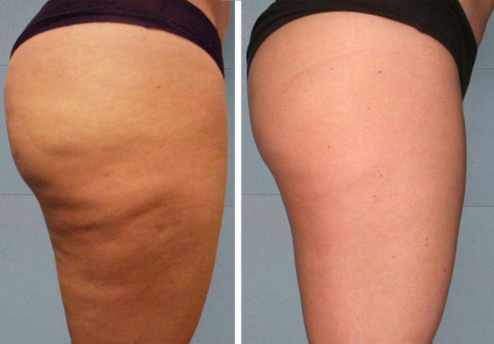 mary kay cellulite cream mary kay cellulite cream