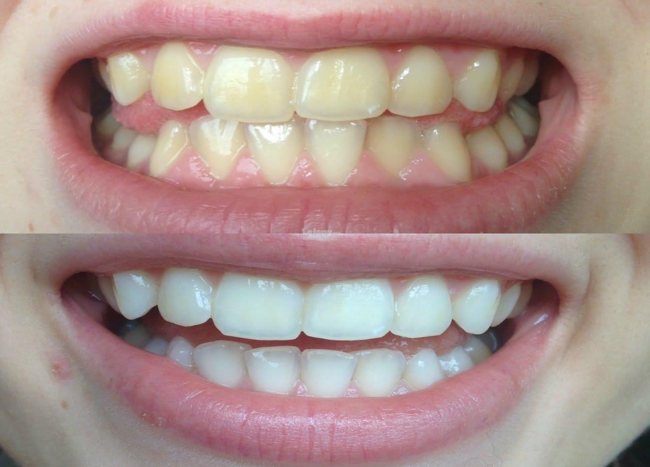 Зубы до и после отбеливания