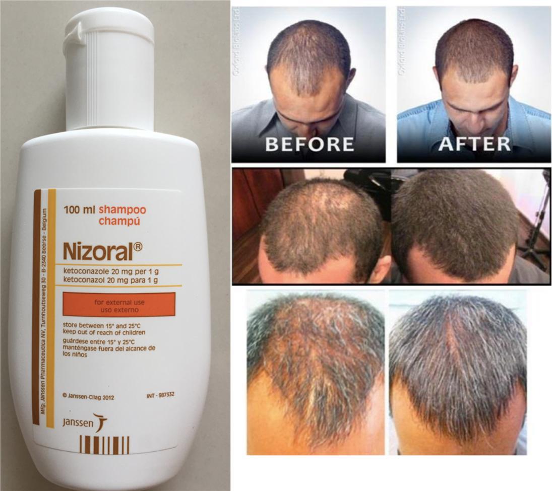 Nizoral shampoo and conditioner 1 hair loss