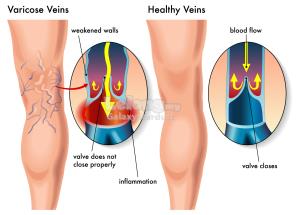 Slim N Shape Compression Legging For Varicose Veins,Knee High&#30246;&..