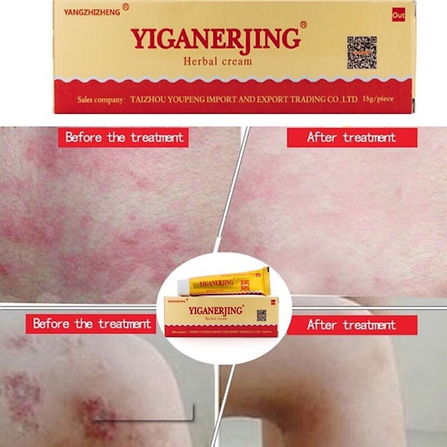 Yiganerjing Mint Eczema Psoriasis Dermatitis Ointment Herbal Cream Skin Care